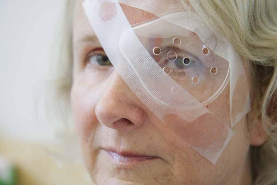 Die Patientin trägt nach der Augen OP, bei der natürliche Linse durch eine künstliche ersetzt wurde, einen durchsichtigen Schutz.